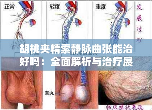 胡桃夹精索静脉曲张能治好吗：全面解析与治疗展望